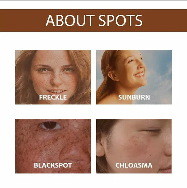 Anti Freckle Serum for Skin Brightening